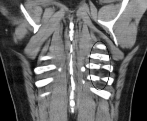 CT scan of BJJ rib injury
